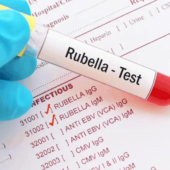 Measles (Rubeola) Antibody, IgM